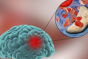 Ischemic brain stroke concept, 3D illustration showing human brain and close-up view of blood vessel obturated with cholesterol plaque